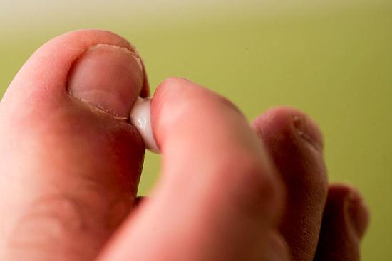 कैसे एक ingrown toenail के इलाज के लिए