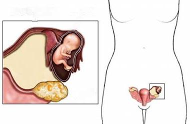 डिम्बग्रंथि पुटी को हटाने के लिए ऑपरेशन