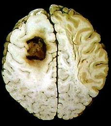 मस्तिष्क कैंसर का पहला लक्षण रोग का संकेत