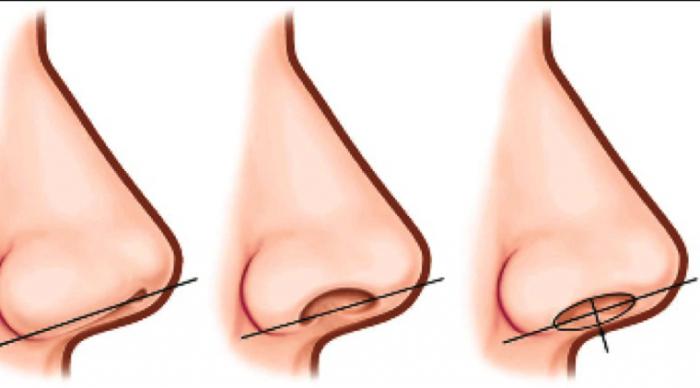 rhinoplasty कीमतें