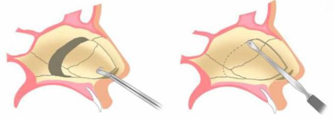 septoplasty postoperative अवधि समीक्षा